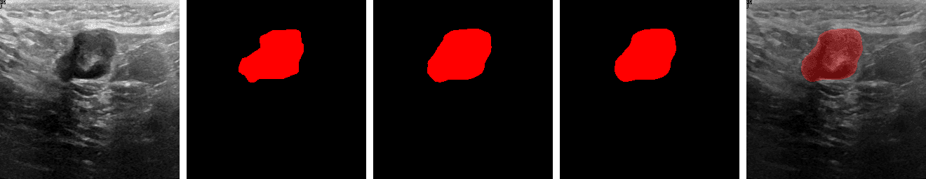 Malignant lesion segmentation result (Jaccard 0.950)